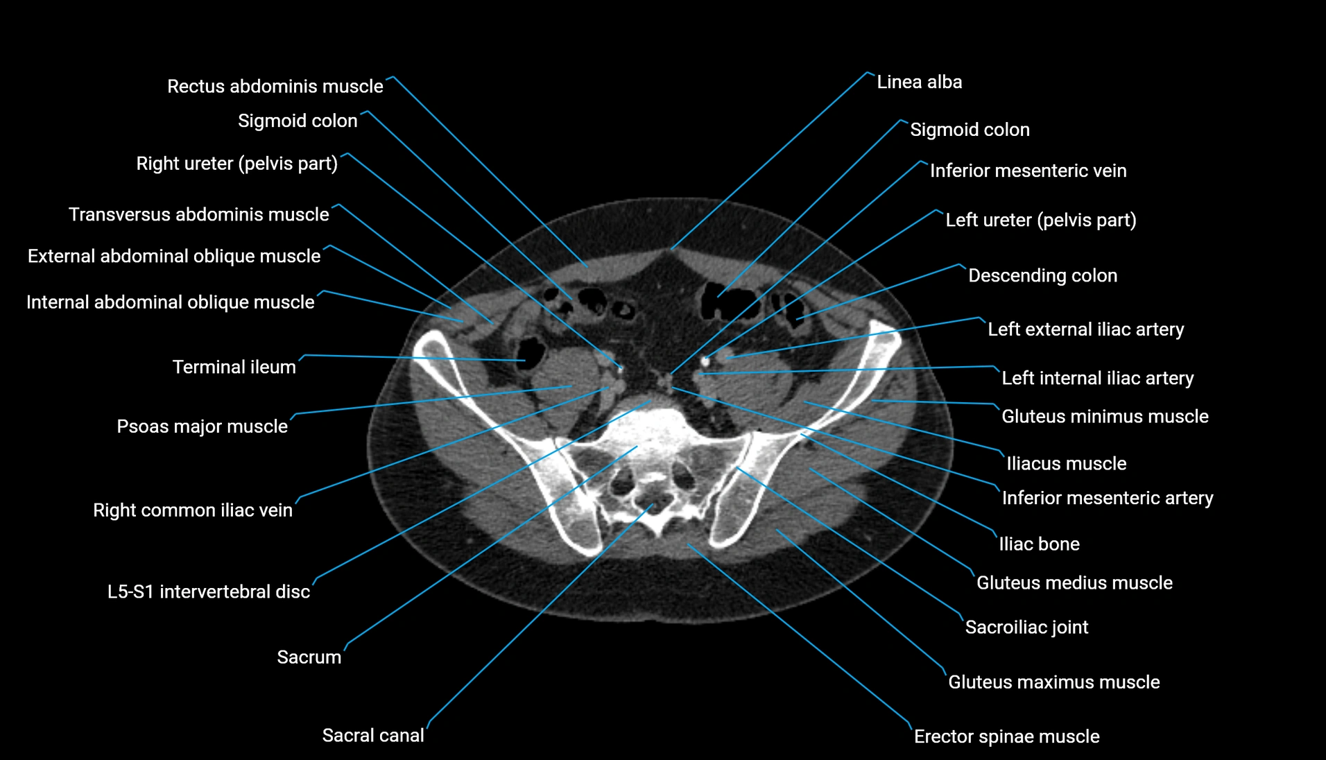 CT urogram axial cross sectional anatomy  labelled radiology image-00185.webp